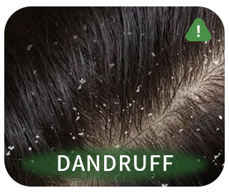 Dandruff