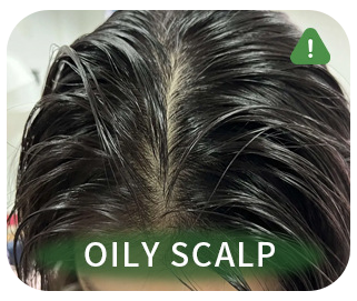 Oily Scalp